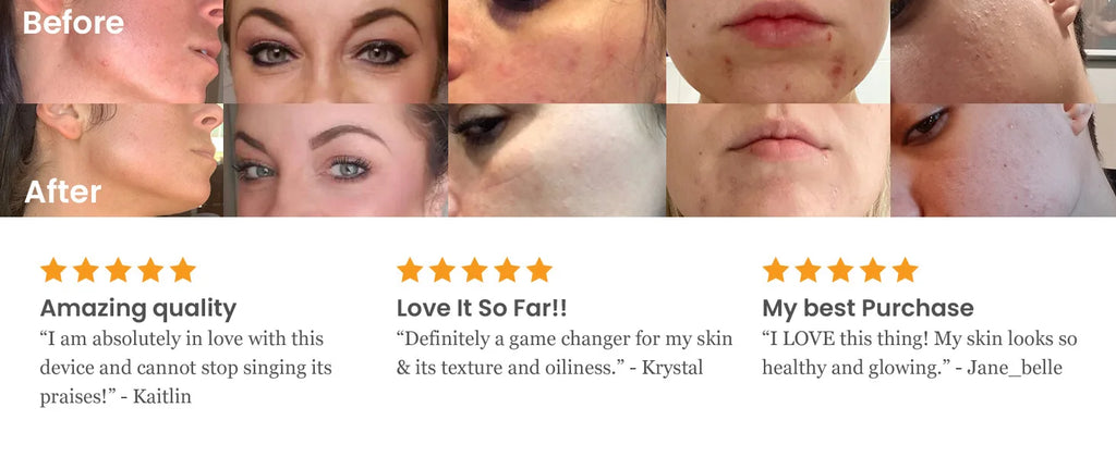 Before and after results using high frequency facial machine